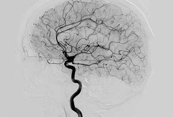 Angiography