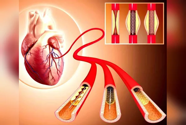 Angioplasty