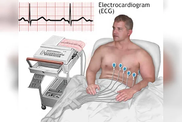 ECG
