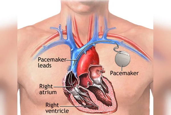 Pacemakers