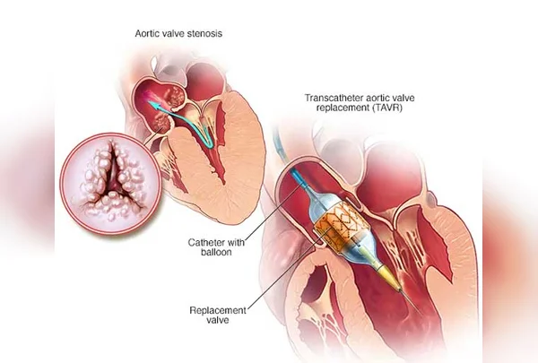 TAVR
